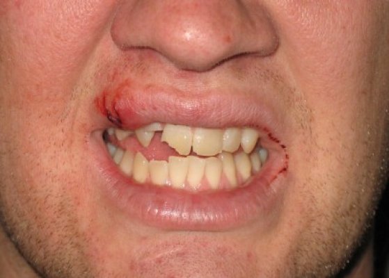 Viorel Tcaci, reprezentantul Asociaţiei Spike din Cernavodă susţine că a fost agresat: Mi-au rupt doi dinţi!